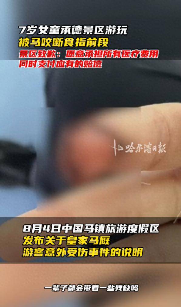 女童喂马被咬断手指 度假区通报：愿意承担所有医疗费用